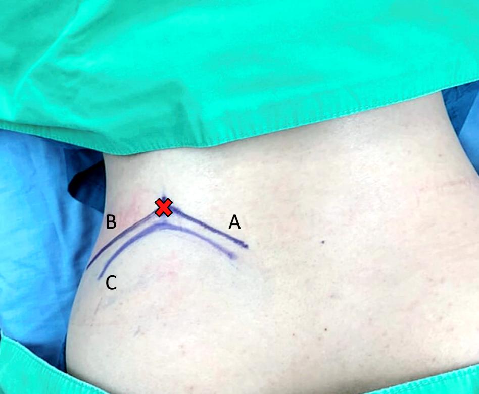 椎间孔镜微创介入治疗椎间盘突出,腰3-4椎间盘突出针刀治疗