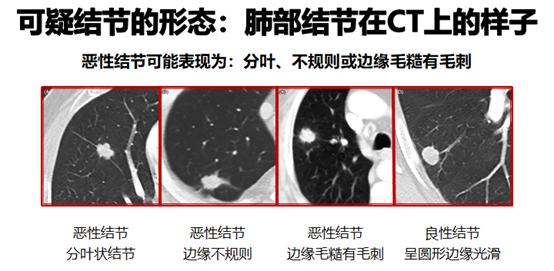 肺结节门诊与胸外科门诊区别,肺结节专科门诊是什么科