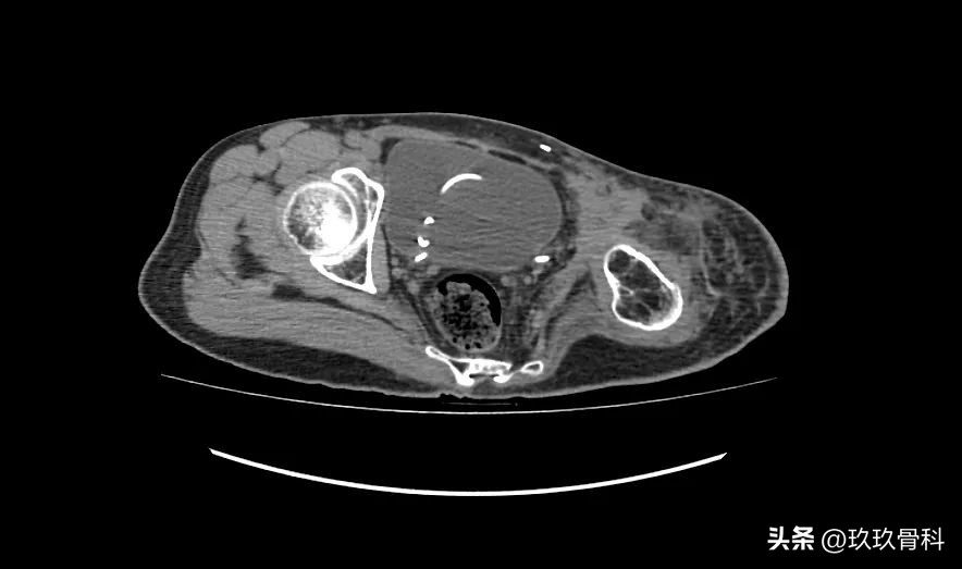 力达康定制型模块化假体治疗“肿瘤切除术后半骨盆缺损”
