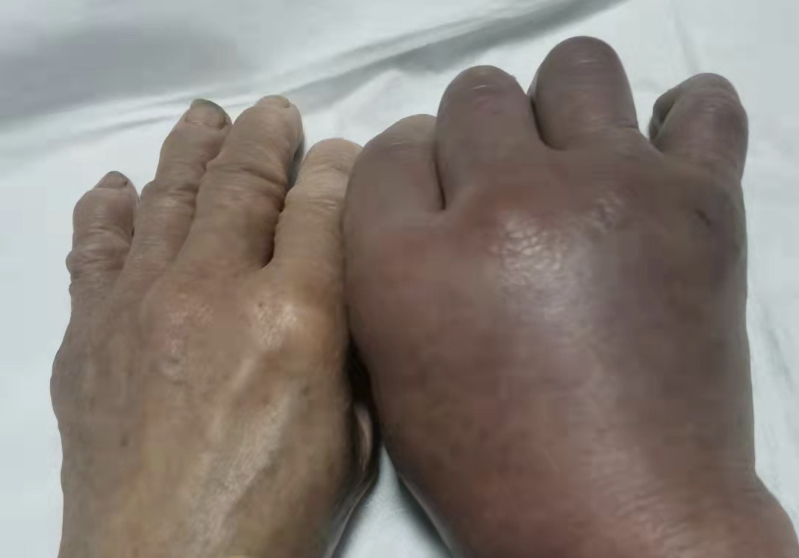 柴房惊现“烂草蛇”！广东66岁老人被咬伤！这是什么蛇？有多毒？