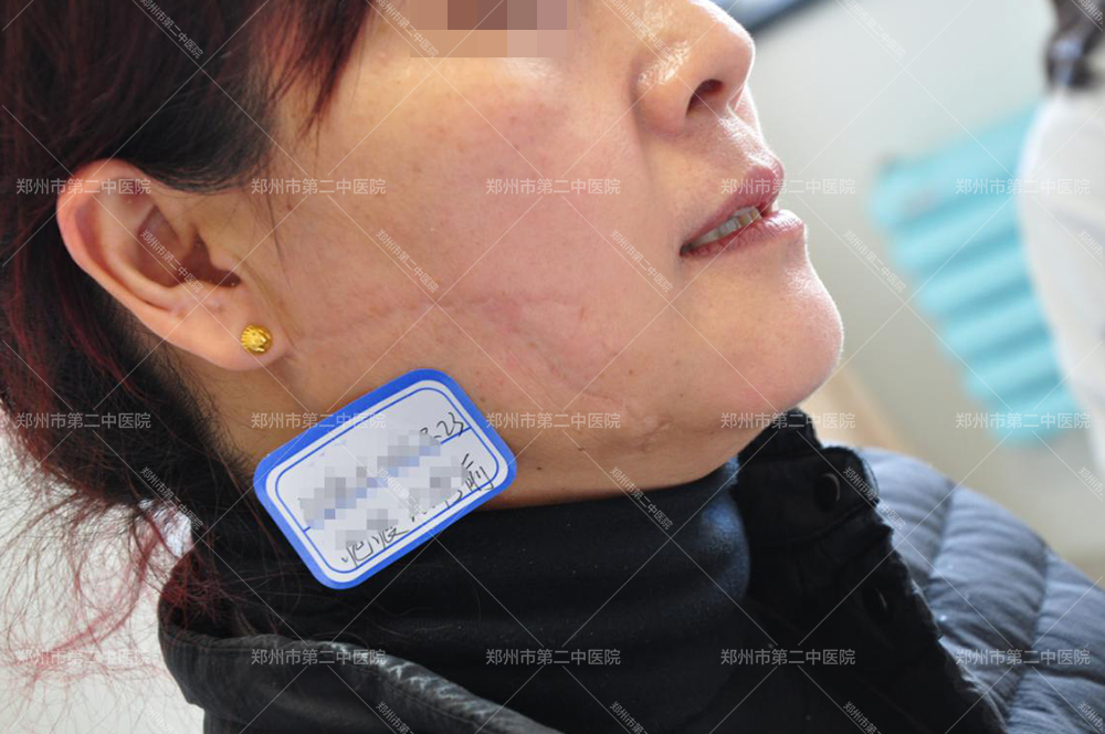 郑州哪家医院修复凹疤痕比较好,郑州祛凹陷疤痕的医院