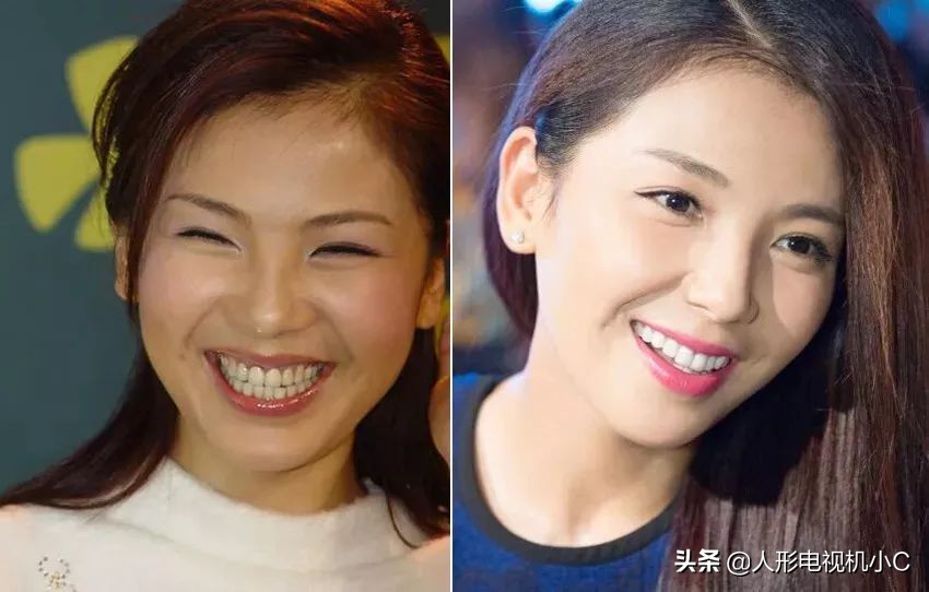 刘涛做的是全瓷牙还是烤瓷牙,刘涛做烤瓷牙的前后对比图