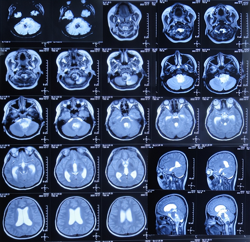 脑干出血儿童,儿童脑干胶质瘤呕吐