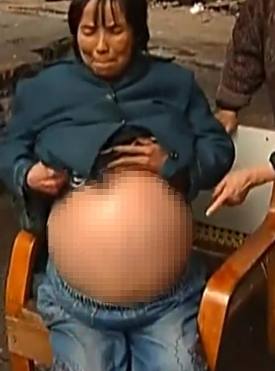 重庆一妇女肚子巨大,女子肚大如球竟是5颗肿瘤