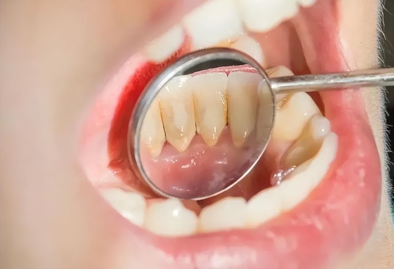 牙结石能直接抠下来吗,牙结石用手可以抠掉吗