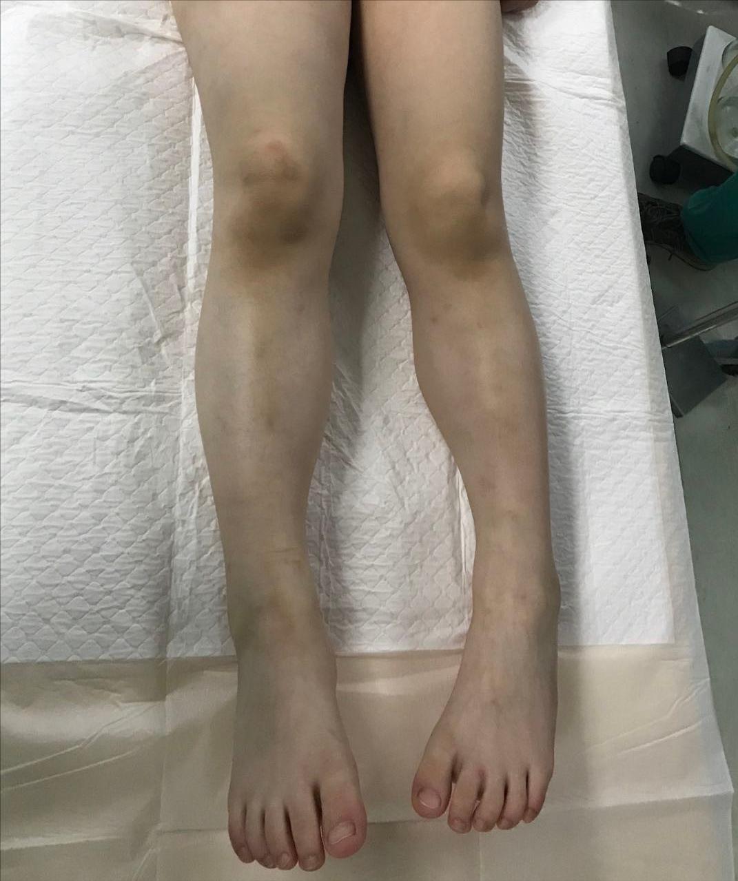 血管畸形伴大静脉瘤扩张,下肢动静脉畸形介入治疗