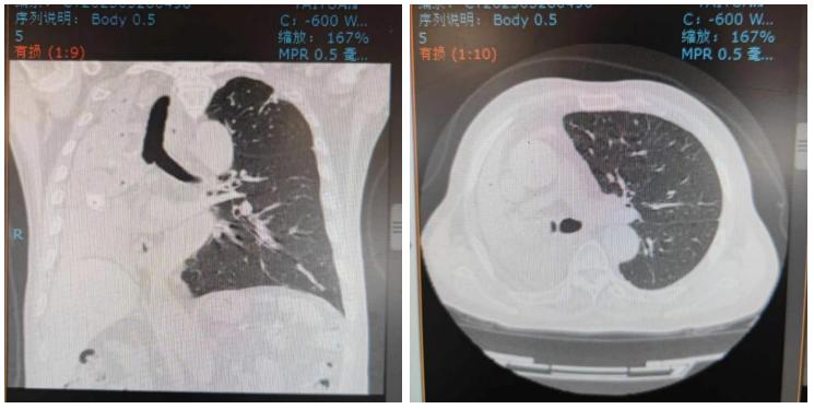 太原市中心医院呼吸介入团队成功开展经气管镜肿瘤微波消融治疗术