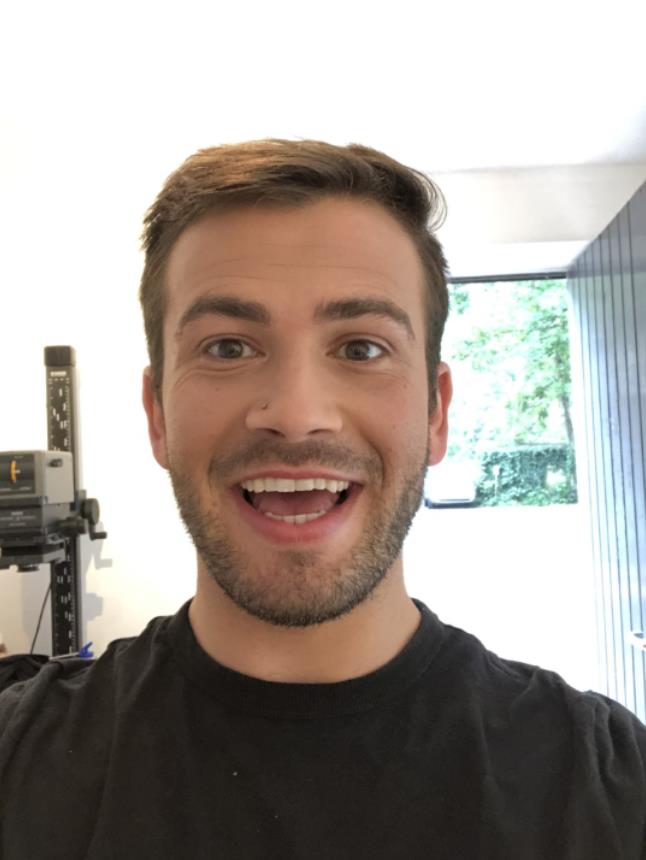 美国男子脱毛,美国男子患罕见疾病天生无锁骨