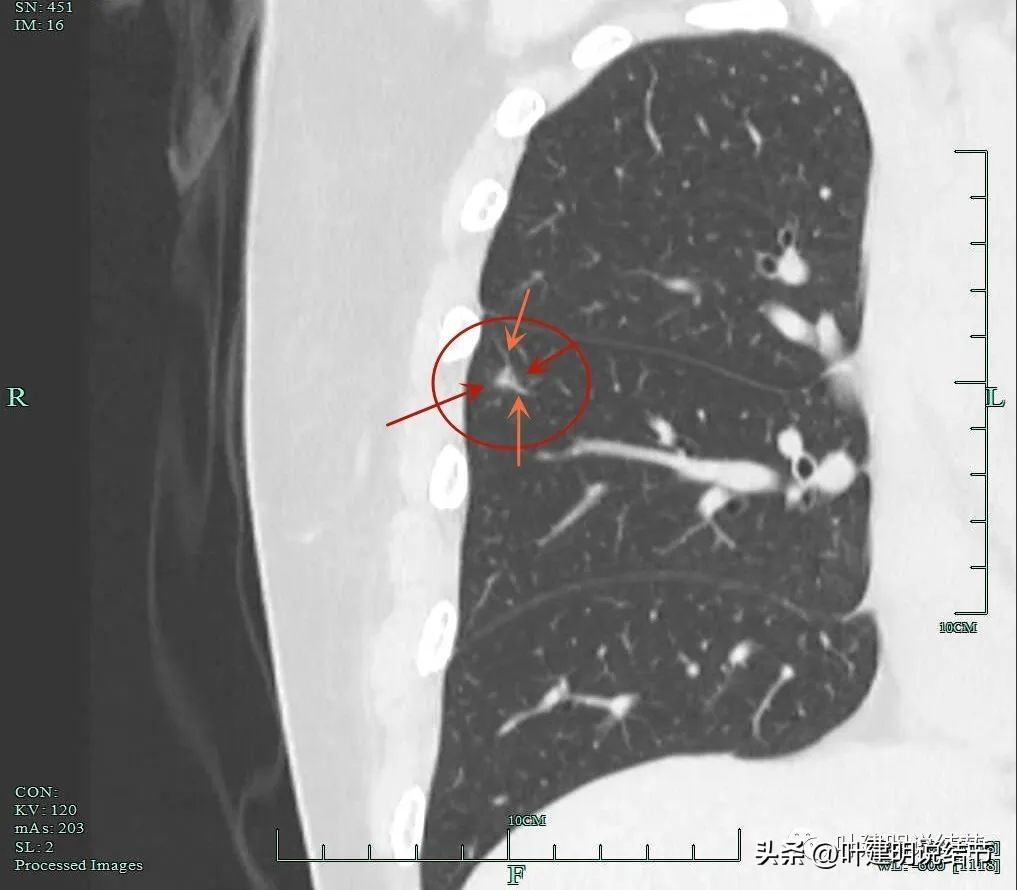肺癌右中上叶全切,右肺上叶小结节查出是癌怎么办