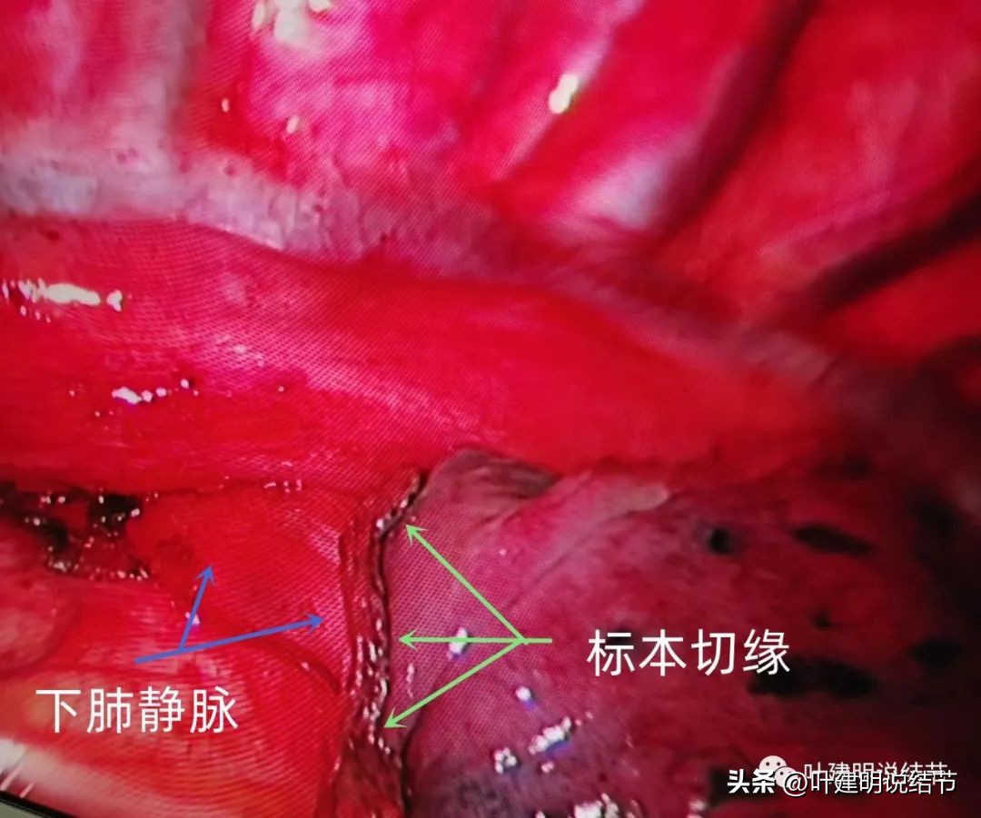 右下叶磨玻璃结节5*4,右下叶磨玻璃样结节多为炎性