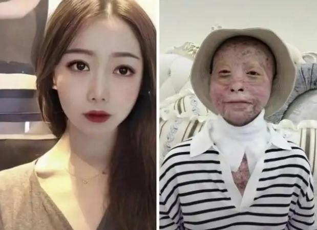 24岁少女烧伤变沧桑老人,12次手术涅槃重生:不被命运摆布的坚强