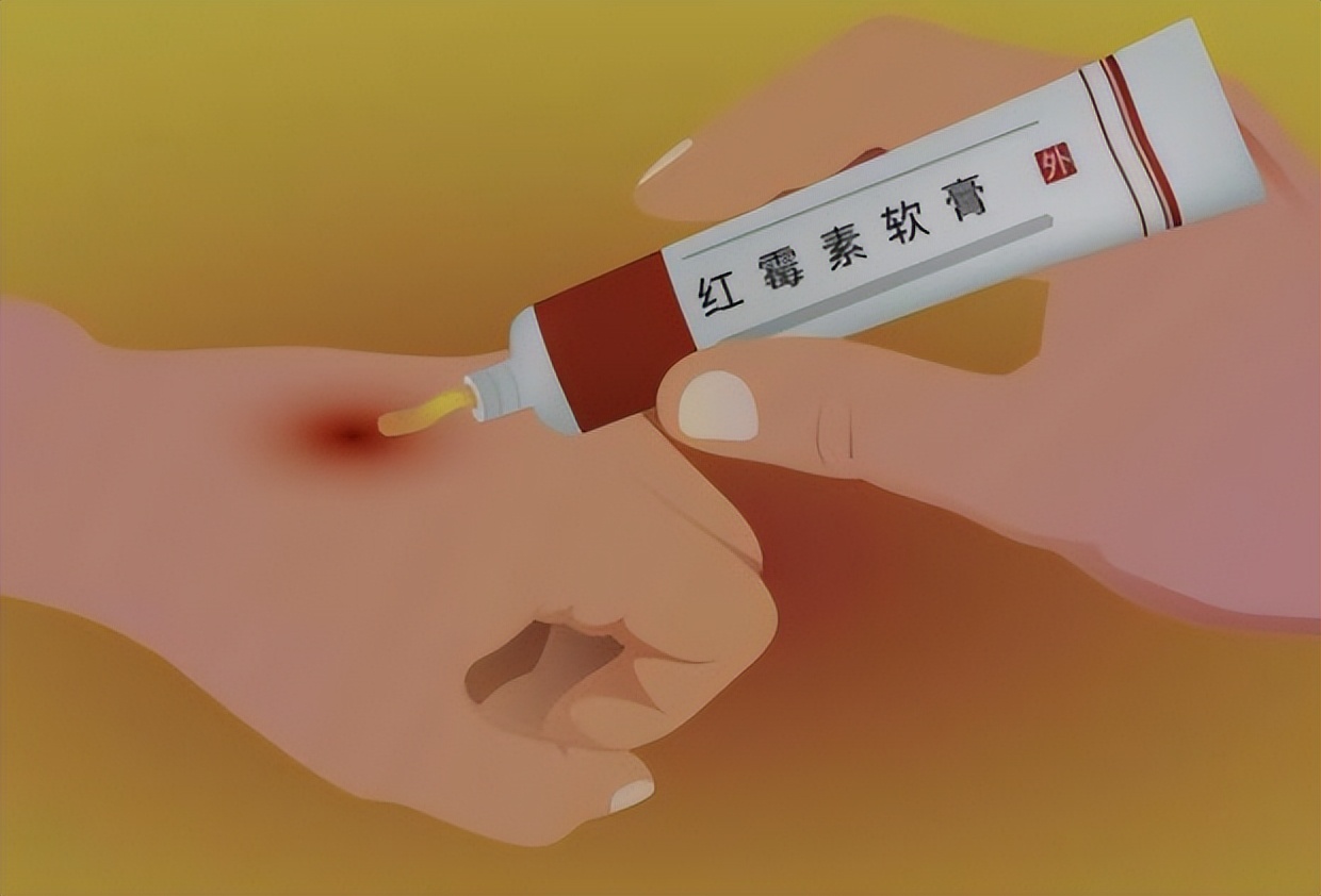 快速消除老年斑的小妙招红霉素,红霉素软膏能去除老年斑吗