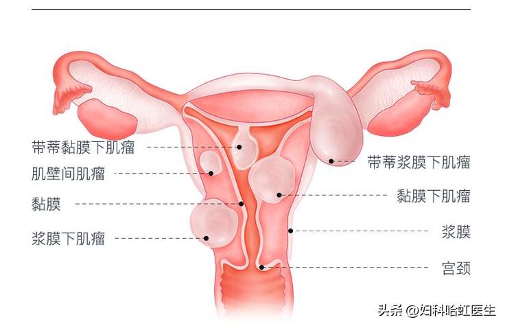 子宫肌瘤看中医有用吗,女性肌瘤有必要治吗
