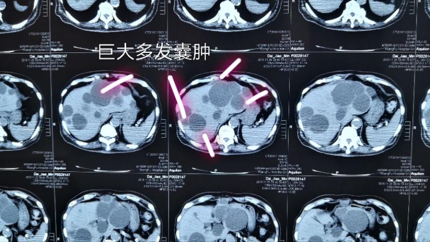 体检发现肝脏有囊肿怎么办,肝上有囊肿要看肿瘤科吗