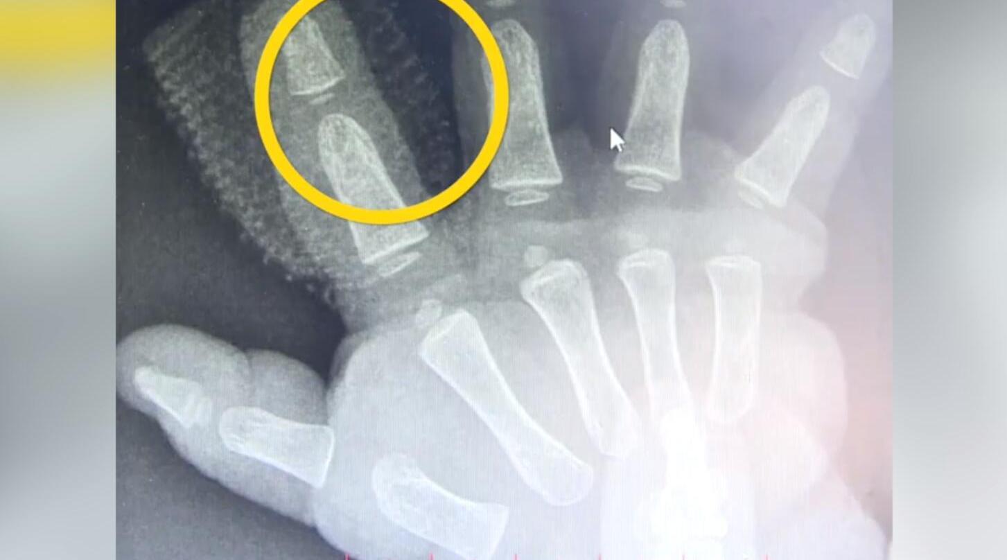 兔子为什么咬小孩的手指,兔子咬断11个月大小孩手指