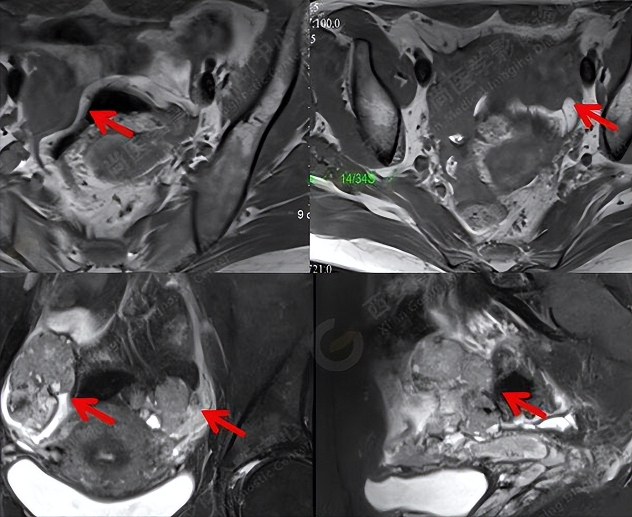 卵巢囊肿b超单怎么提示,卵巢b超报告周边有血流信号