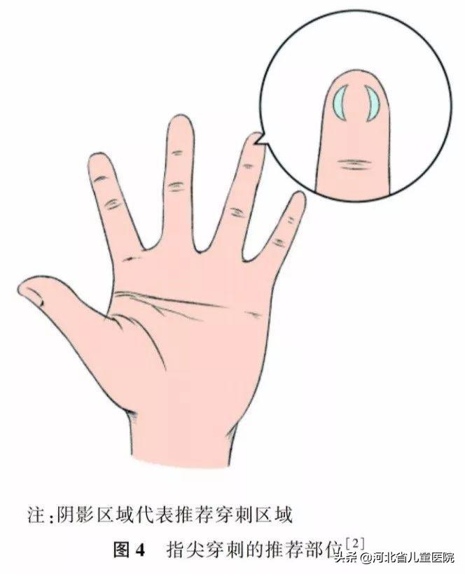 儿童静脉采血指南,婴幼儿末梢采血方法