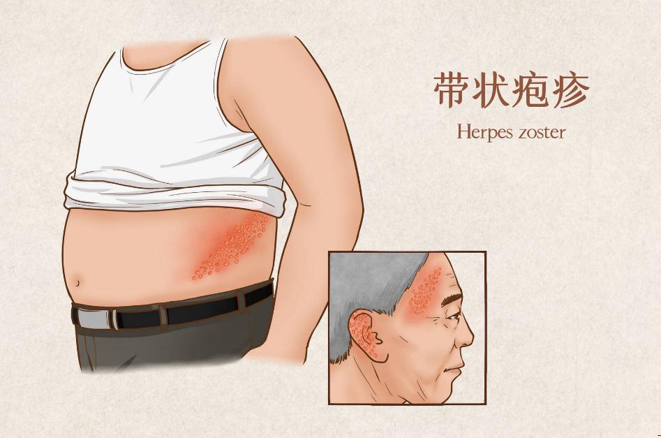带状性疱疹的疼痛有何方法治疗,头上长带状疱疹怎么才能快速治愈