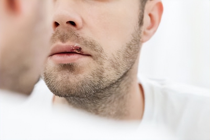 烂嘴角是怎么回事是上火吗,烂嘴角到底是什么病