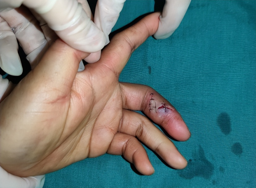 大妈被鱼咬处理结果,阿姨买鱼被鱼咬后续