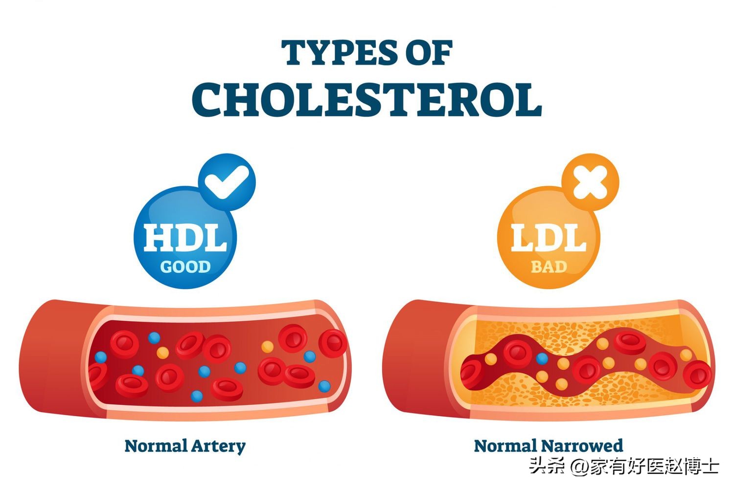 颈动脉没有斑块可以停用他汀吗,一般他汀吃多久颈动脉斑块有效果