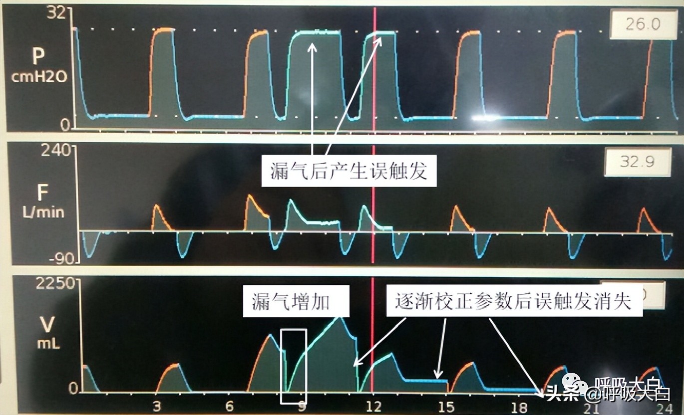 无创呼吸机与有创呼吸机设定区别,使用无创呼吸机时有哪些错误做法