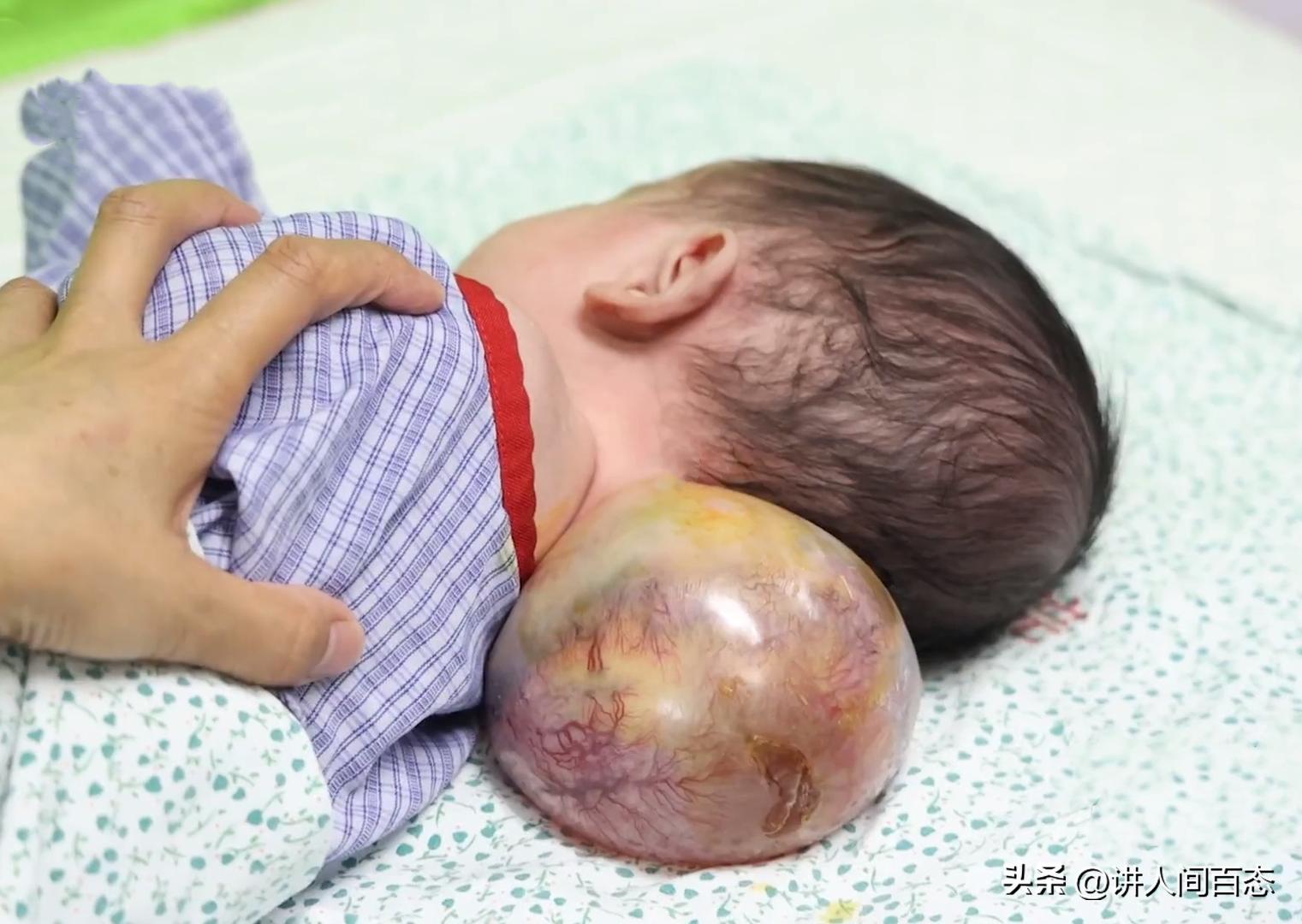 被丢在桥洞下的孩子后续,孩子被遗弃后脑长肿瘤