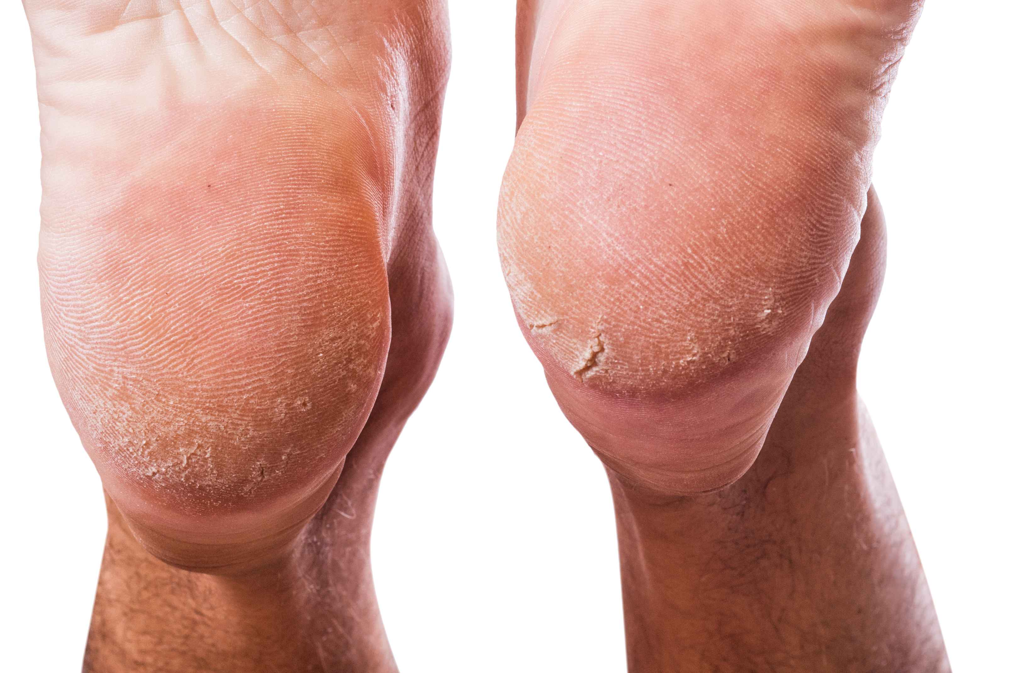 脚后跟总是干裂起皮的人注意,脚后跟干裂什么原因引起的怎么治