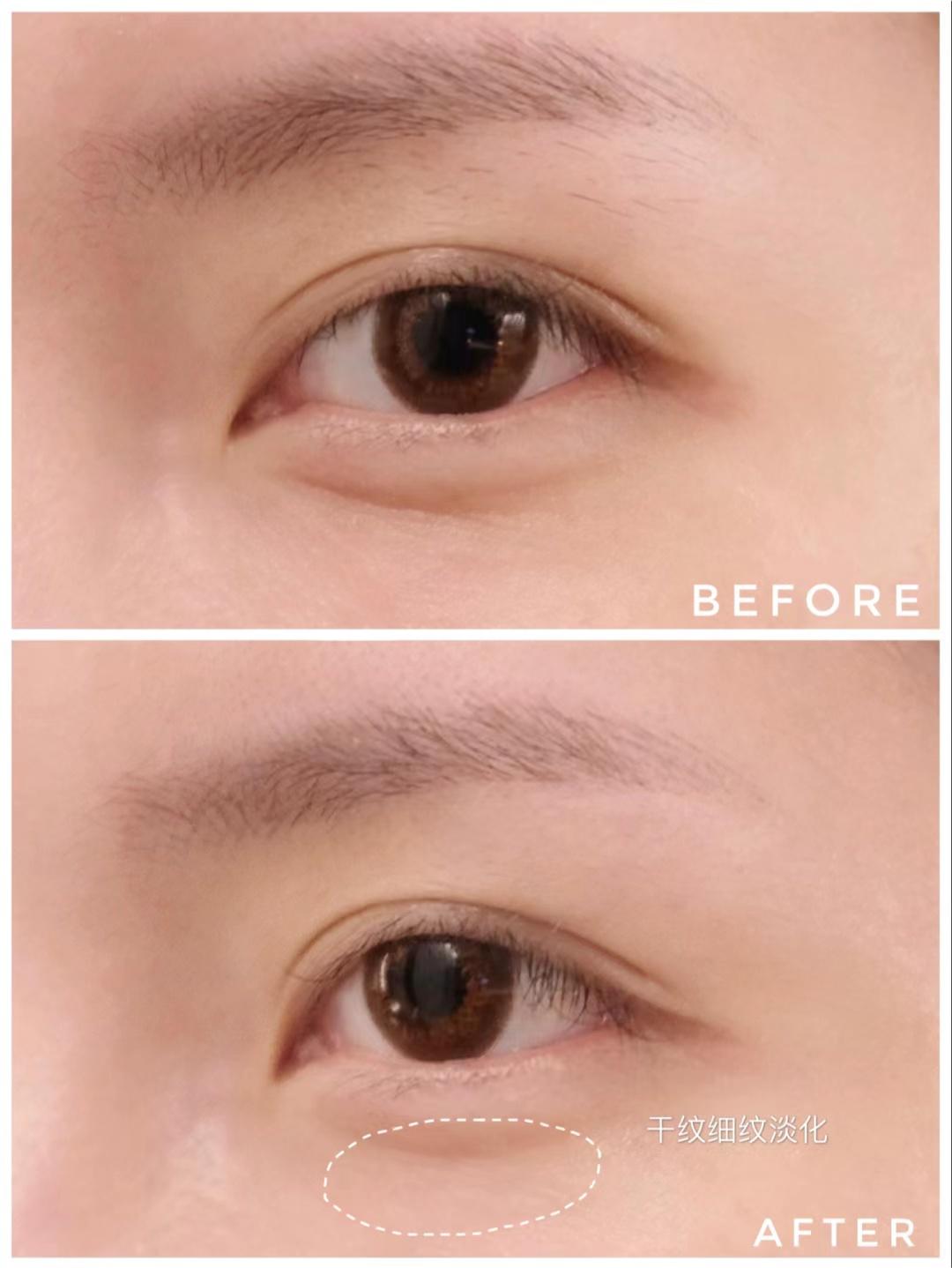 眼霜搓泥好还是不搓泥好,眼霜涂脸还是硅霜涂脸好