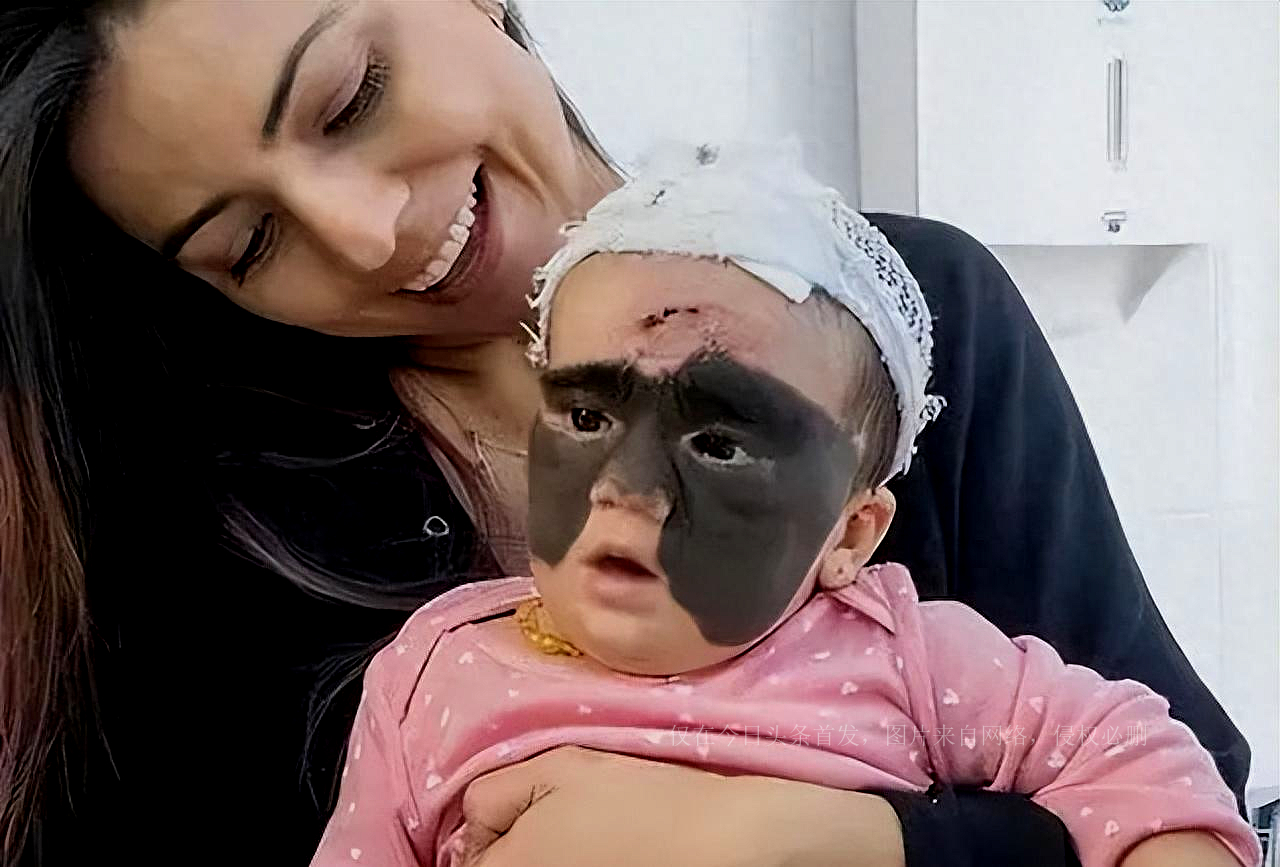 还记得天生胎记酷似“蝙蝠侠”的女婴吗？6次整容后，仍需治疗
