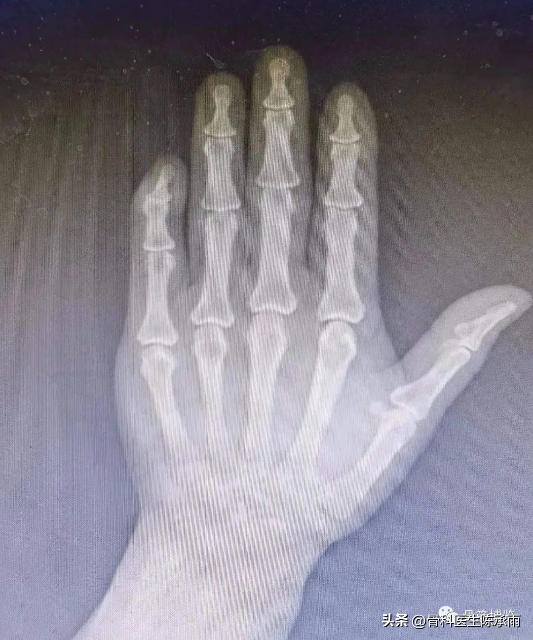 手指出现锤状畸形不要太紧张，看后知道伸肌腱止点断裂重建术