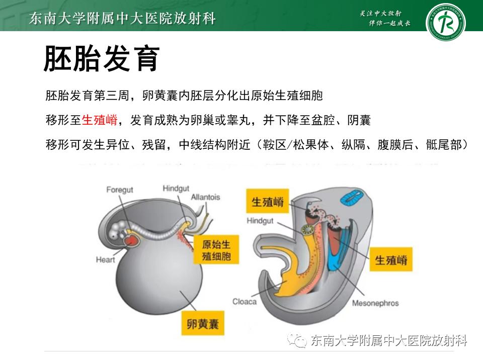 好文分享值得深思,纵隔精原细胞瘤