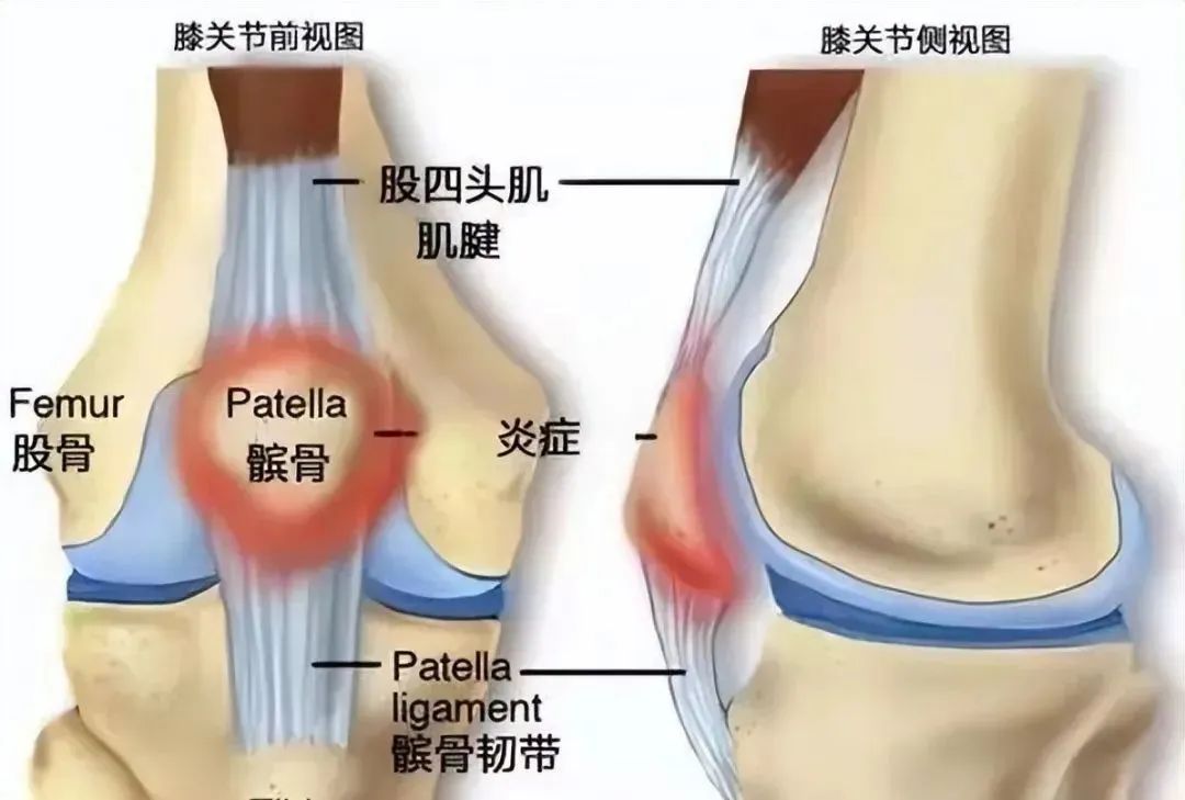 跑步踝关节疼痛与臀部有关,跑步膝盖疼踝关节疼