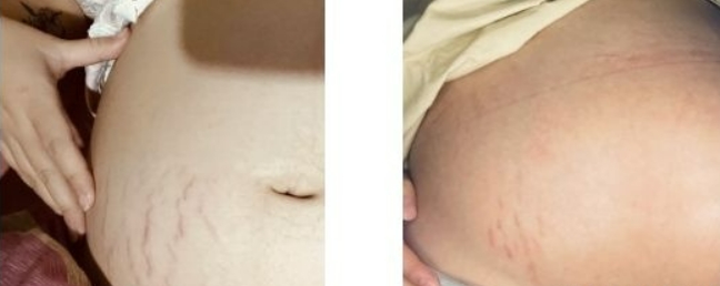 防妊娠纹产品推荐孕妇使用吗,预防妊娠纹产品推荐口碑