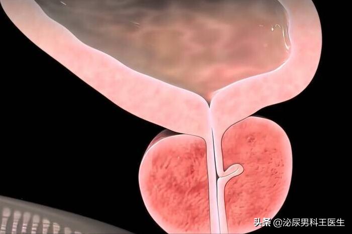 治疗前列腺增生最好的三种药,前列腺增生钙化吃什么药物有效