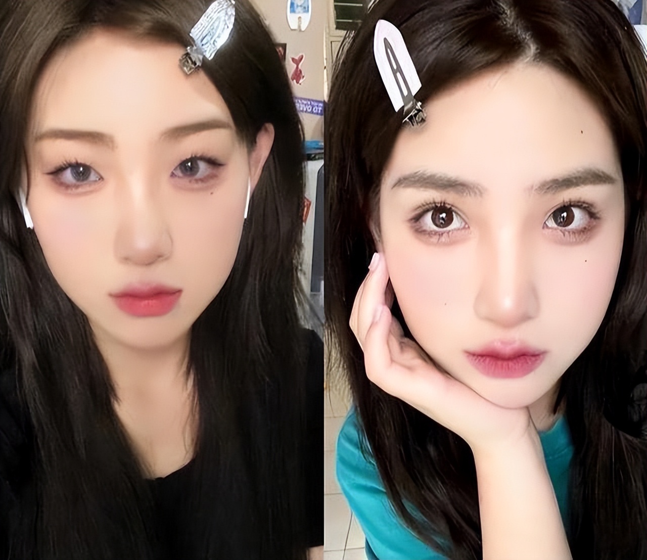 双眼皮手术前后干货,眼皮凹陷割双眼皮十个有九个后悔