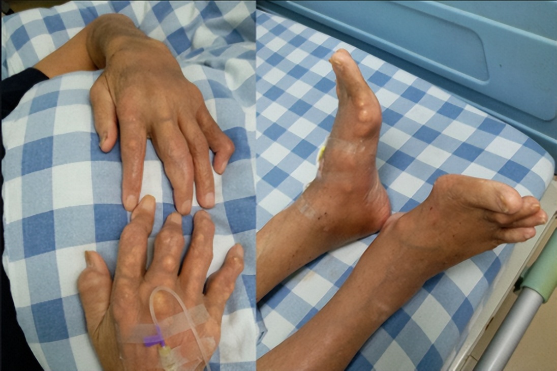 重庆市痛风专家高锋,高锋医生