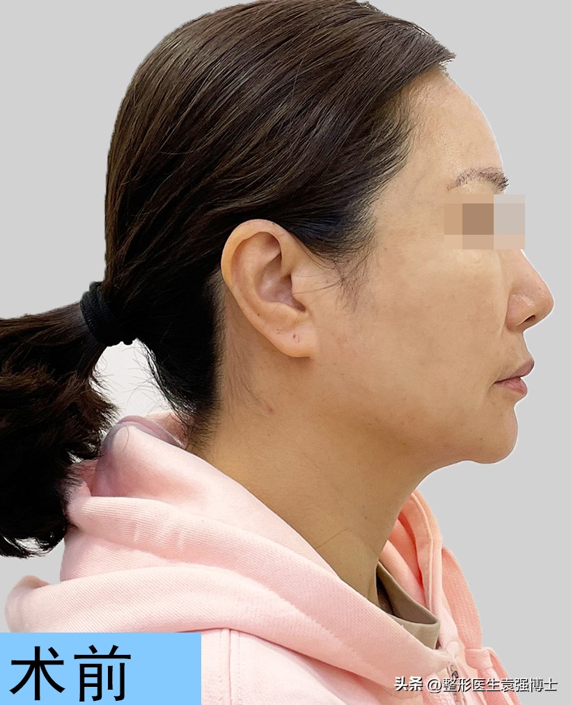 44岁女士拉皮除皱,50岁女人面部拉皮