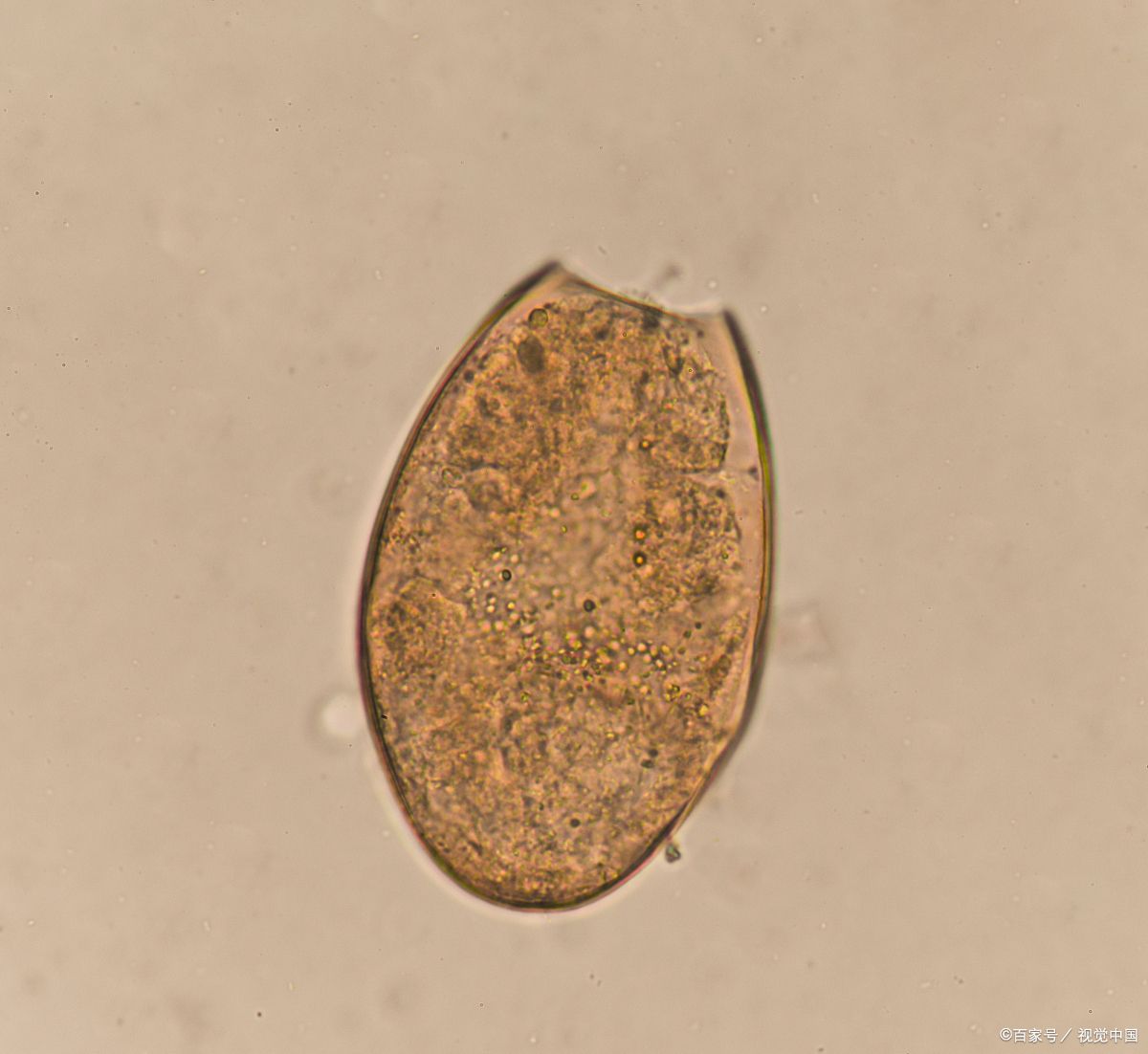 一男子吃生鱼片浑身寄生虫,一男子吃蔬菜导致全身都是寄生虫