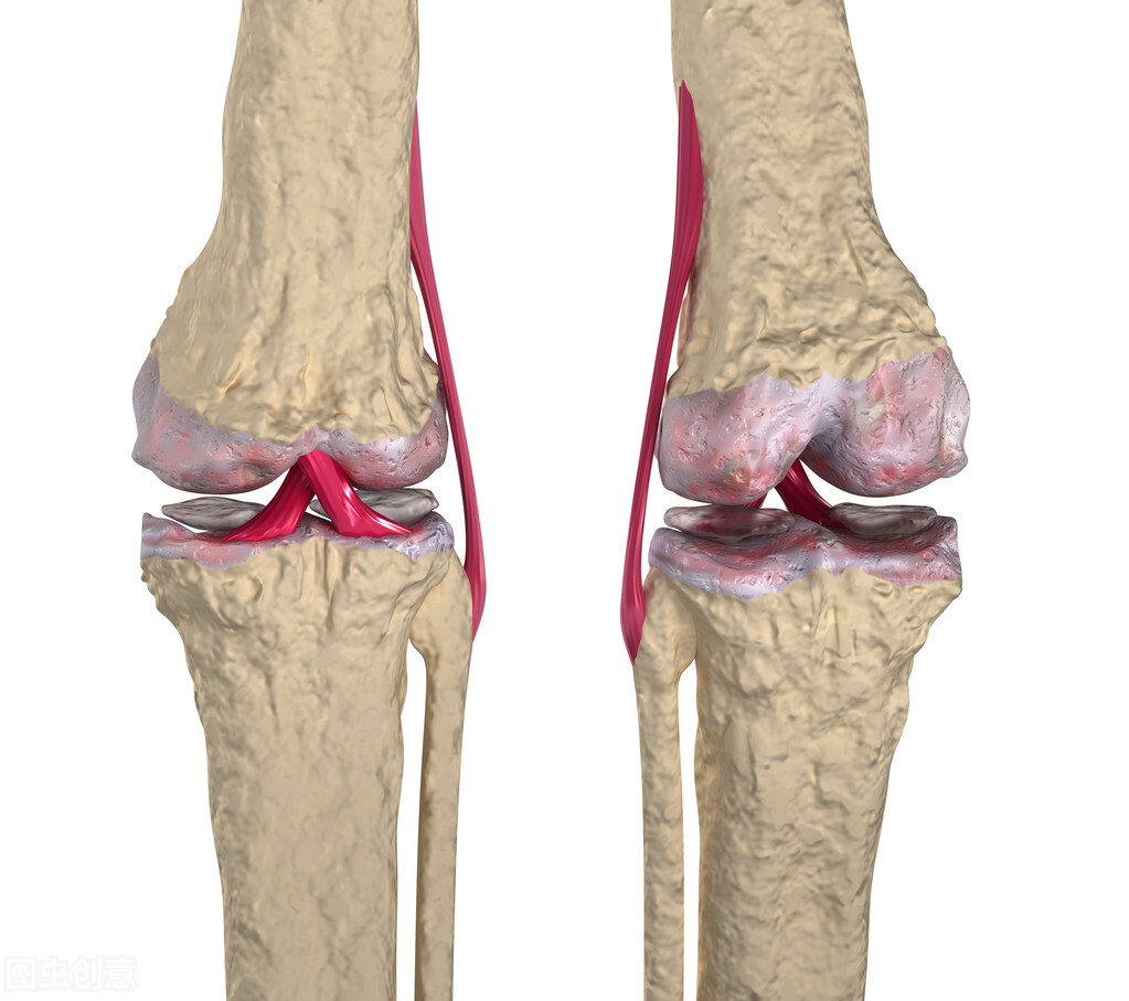 全膝关节置换技术分析,膝骨性关节炎的临床诊断标准
