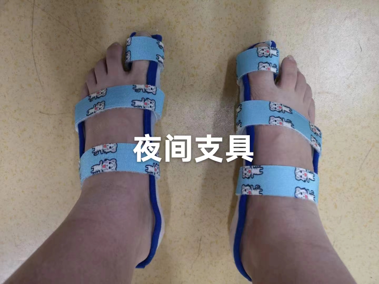 儿童拇外翻如何干预,儿童拇外翻可以治疗吗