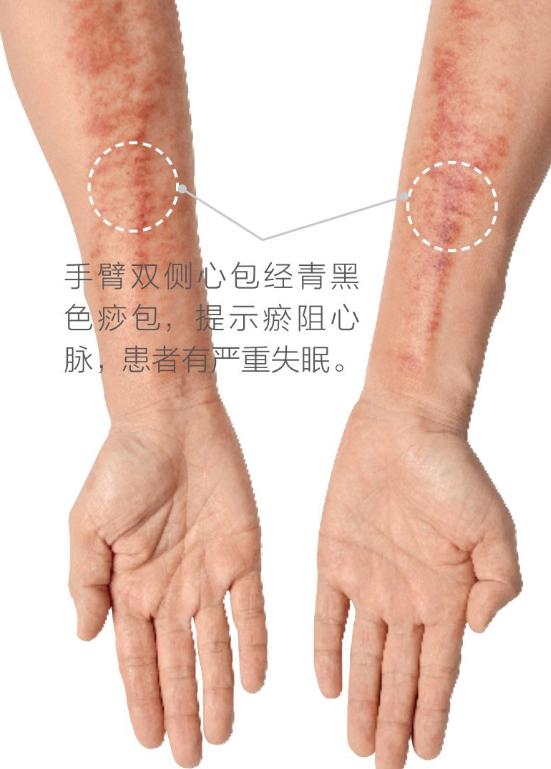 刮痧后痧疹怎样辨别,刮痧前胸出痧图与病症对照