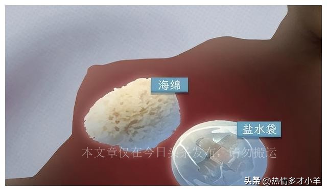 人类“隆胸”发展史:第一批“隆胸”的女人,后来都怎么样了?