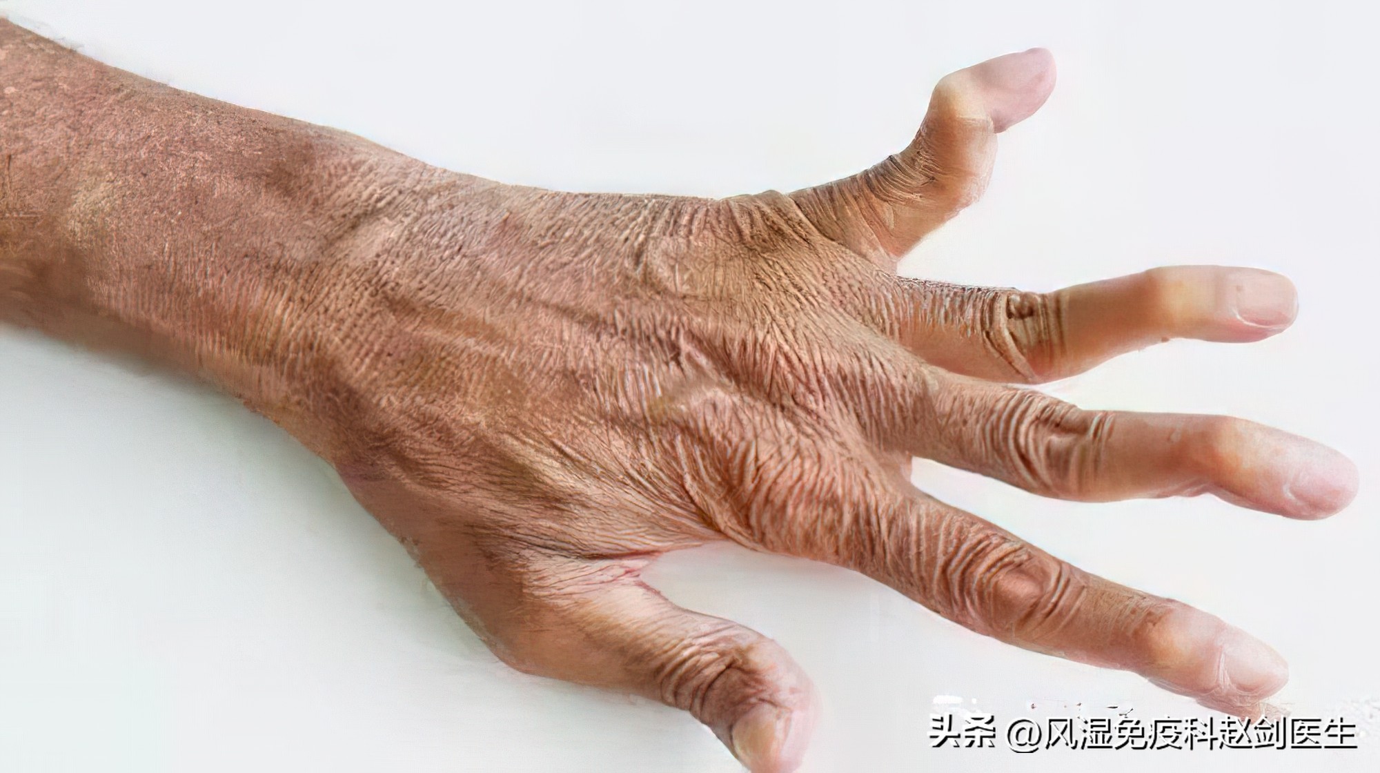 做好6种自我管理，类风湿患者不担心病情反复和残疾