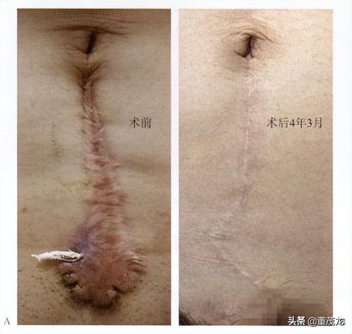 董茂龙说医:瘢痕的放射治疗