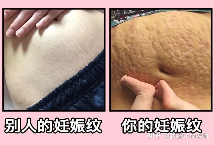 妊娠纹用什么方法可以修复,妊娠纹可以修复吗