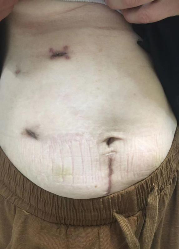 小刀口怎么处理可以快速愈合,十大愈合伤口秘方