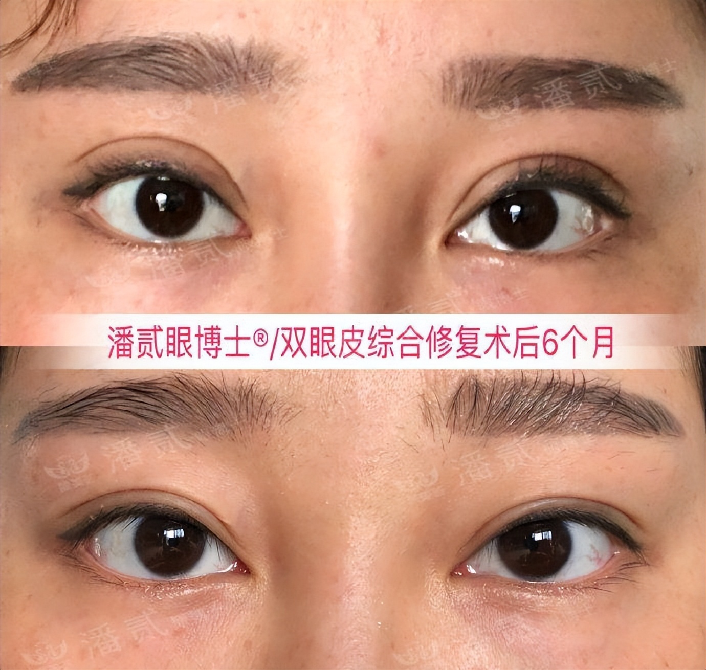 埋线双眼皮如果不满意怎么修复,切开双眼皮失败可以用埋线修复吗