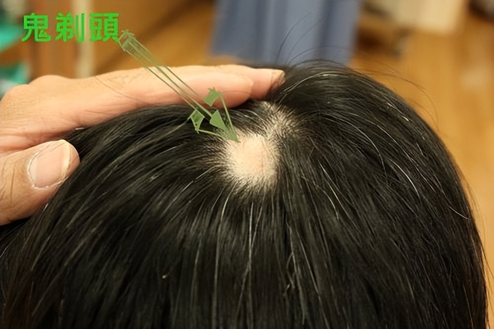 老是鬼剃头是怎么回事,鬼剃头是怎么回事