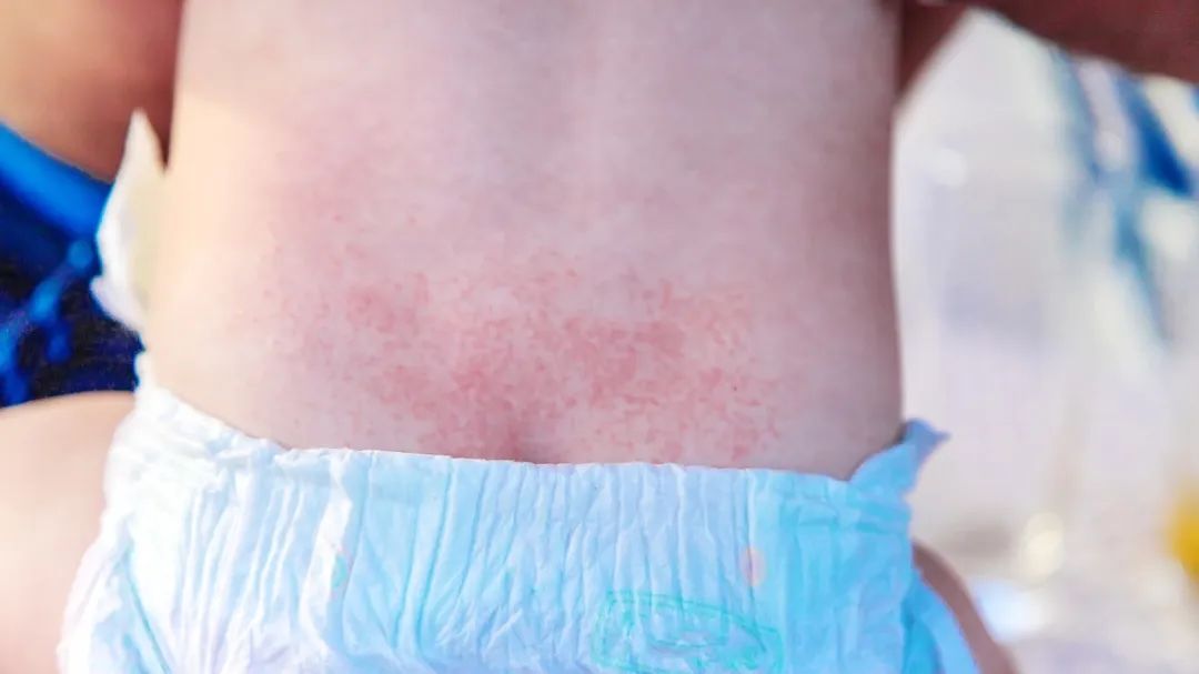 孩子过敏鼻炎湿疹怎么办,过敏湿疹的症状和表现